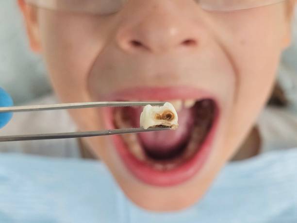 Best Emergency Dentist for Lost Fillings or Crowns in Haslet, TX